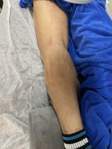 腰傷治療篇