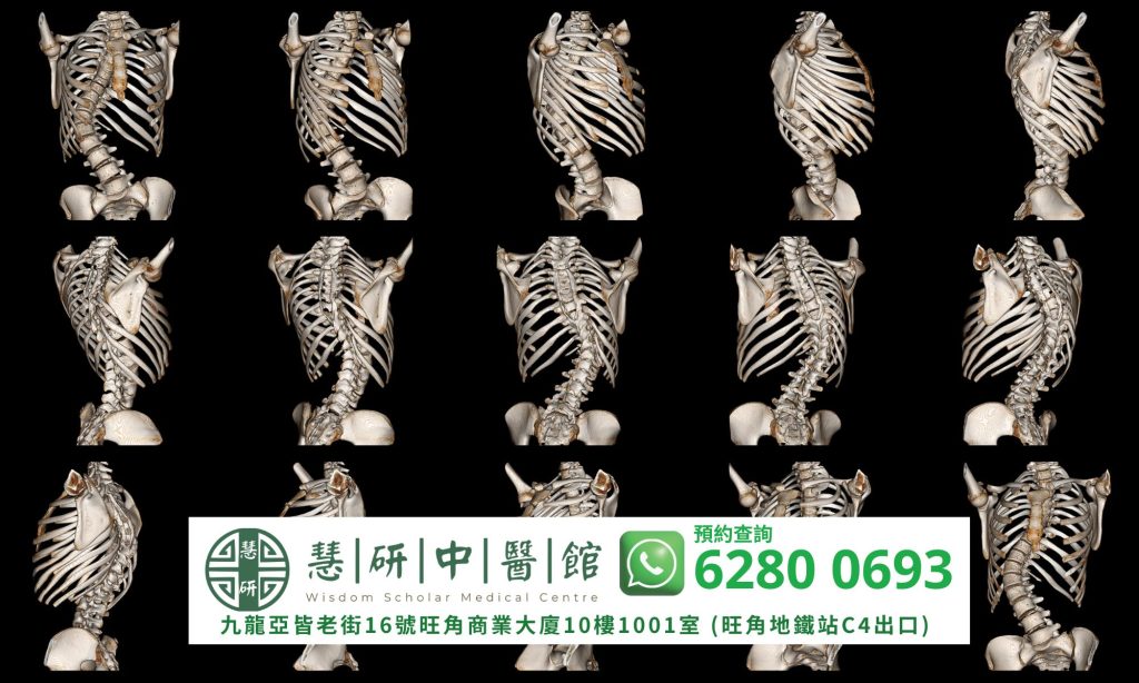 脊柱側彎透視圖