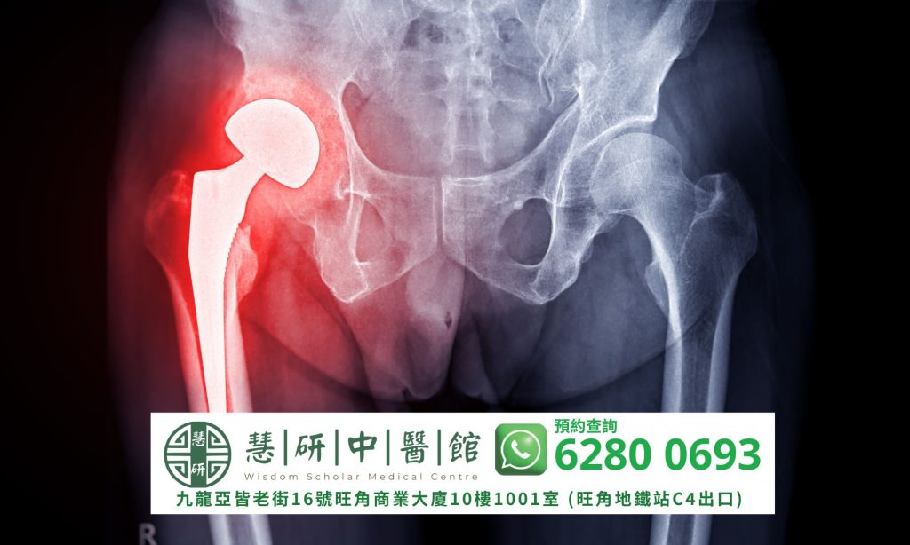 中醫推拿舒緩髖關節痛